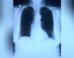 A photo of a lung xray